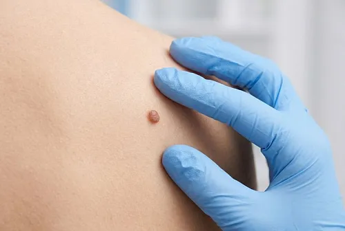 Удаление фибром