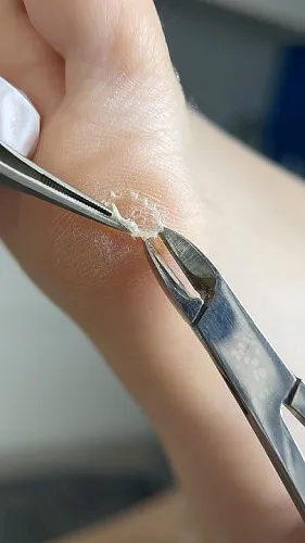 Удаление и обработка мозолей на ногах