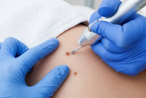 Удаление родинок (невусов)