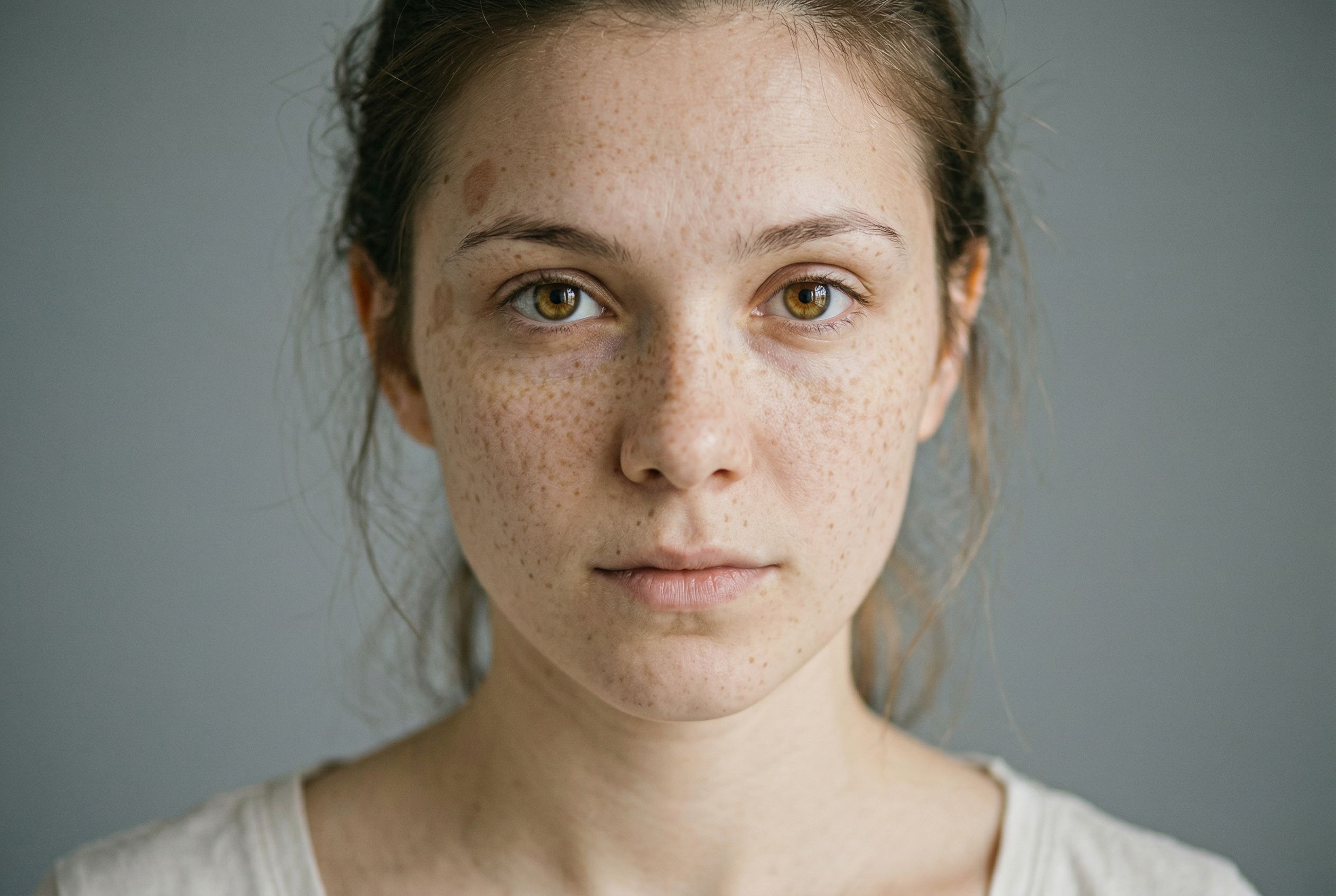 Удаление пигментации