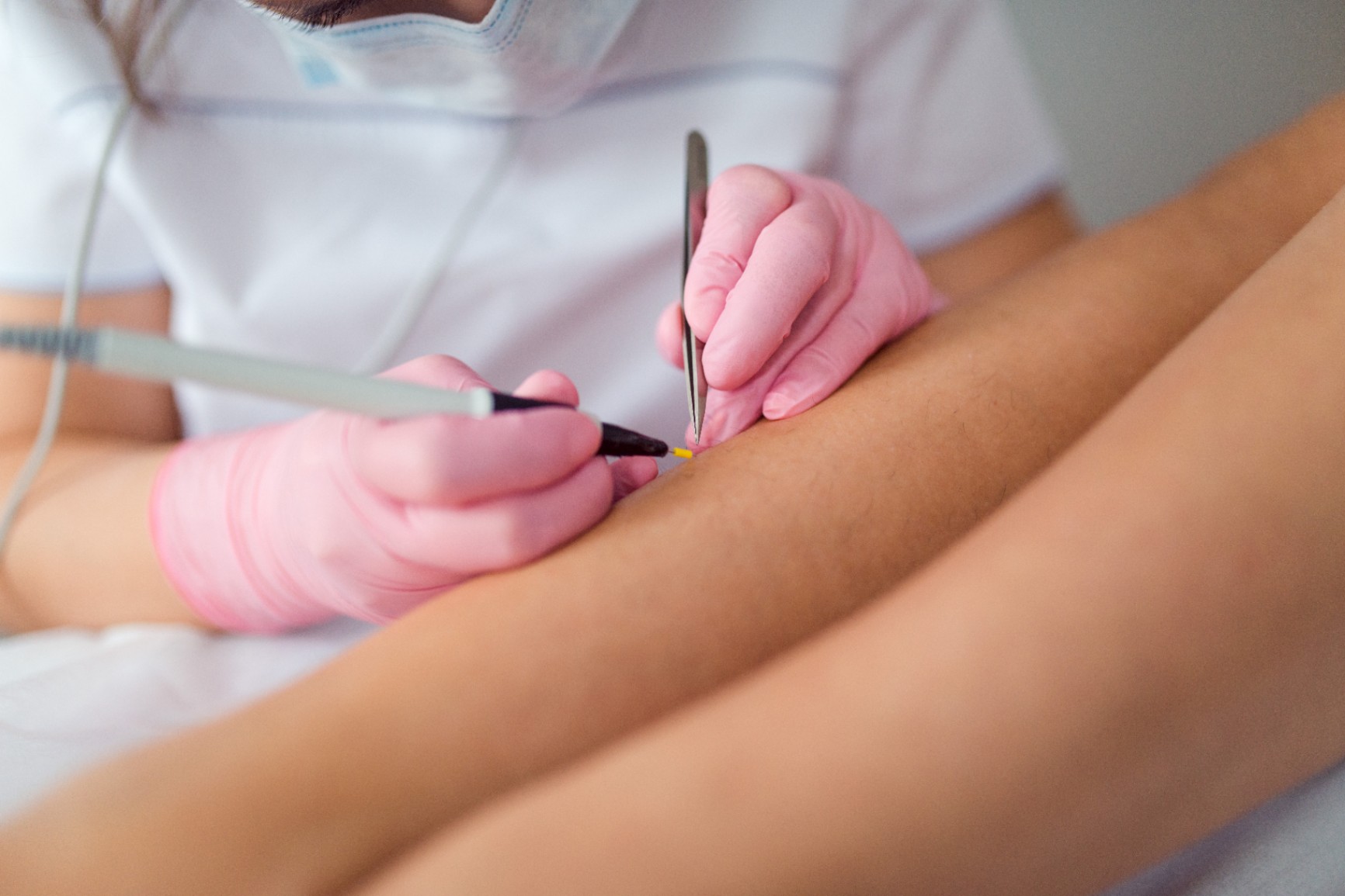 Электроэпиляция