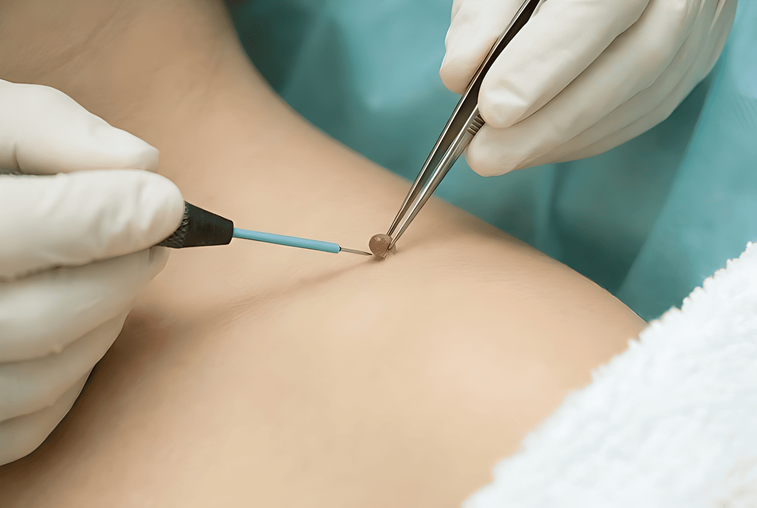 Удаление папиллом