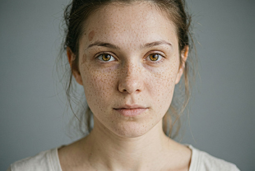 Удаление пигментации