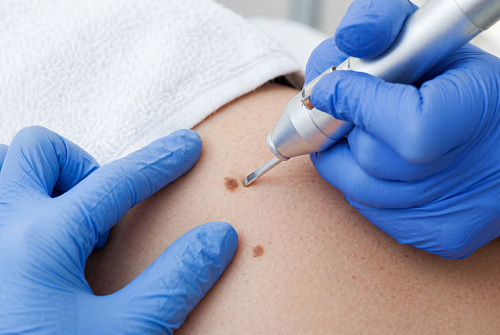 Удаление родинок (невусов)