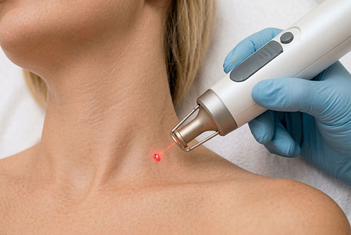 Удаление папиллом