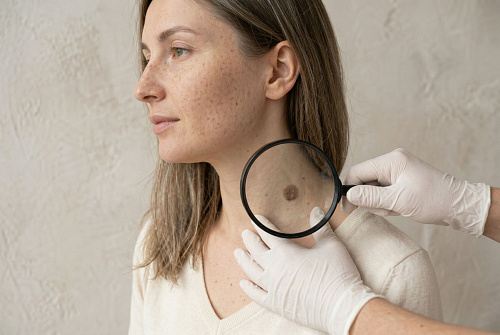 Удаление кератом