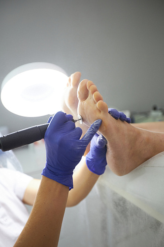 Удаление и обработка мозолей на ногах